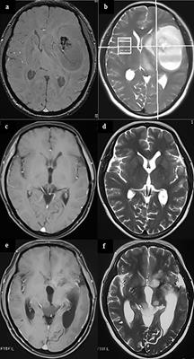 Multicentric Glioma: An Ideal Model to Reveal the Mechanism of Glioma